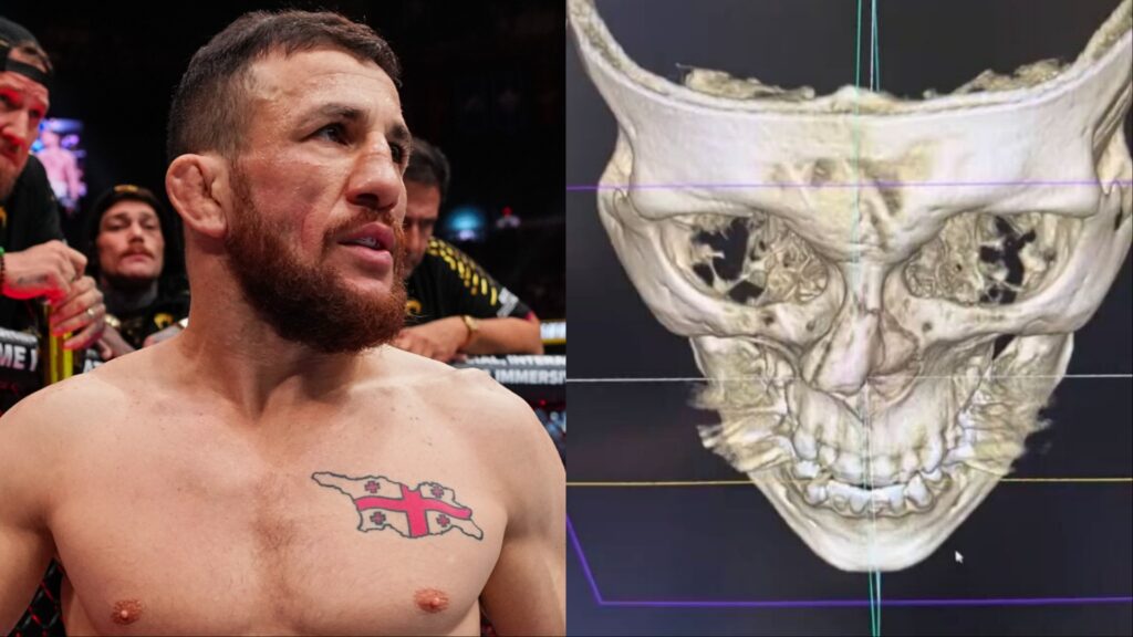 Merab Dvalishvili and a screenshot of his X-Ray shared to Instagram